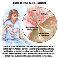 Viata cu reflux acid (sau boala de reflux gastroesofagian)